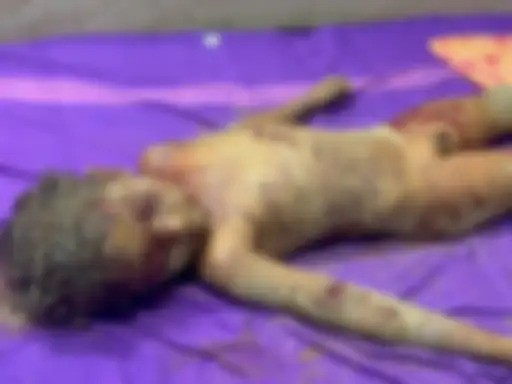 Korba Breaking: 5 वर्षीय बच्चे पर आवारा कुत्तों का जानलेवा हमला, ग्रामीणों में भारी आक्रोश
